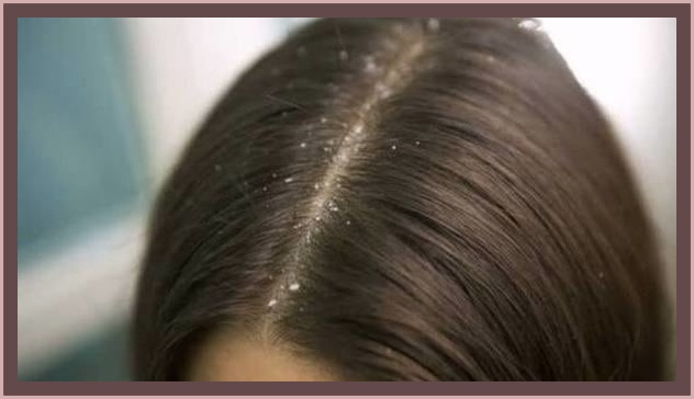 وصفات لقشرة الشعر