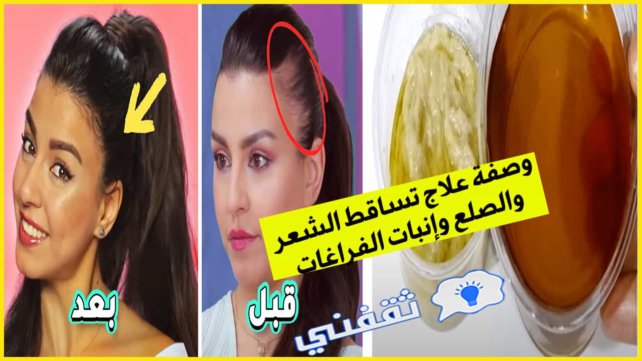 وصفة علاج تساقط الشعر