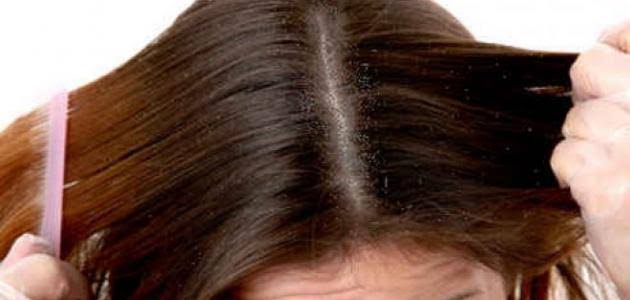 أعشاب طبيعية لعلاج قشرة فروة الشعر والتهاباتها ثقفني