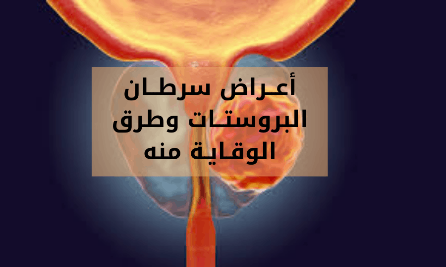 أعــراض سرطـان البروستات prostate cancer وطرق الوقـايـة منه