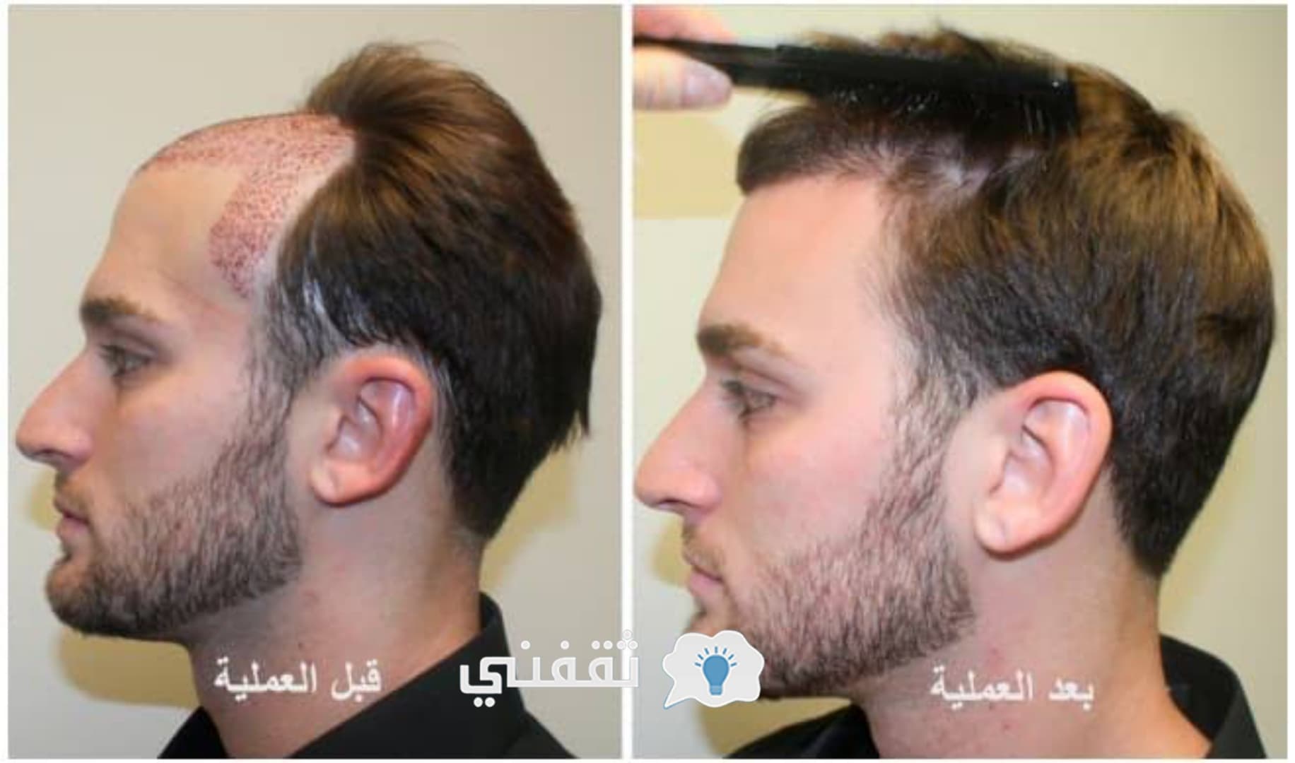 عملية زراعة الشعر تخلص من الصلع في اقل من 8 شهور Hair Transplant