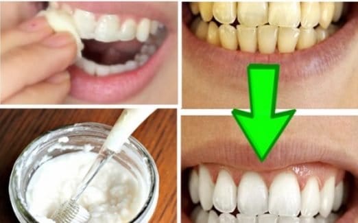 تبييض الأسنان في 5 دقائق والتخلص من أصفرار الأسنان بوصفات طبيعيا 100٪ فعال