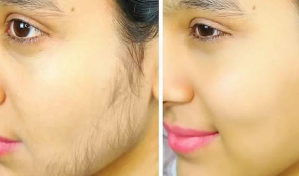 وصفات طبيعية لإزالة شعر الوجه الزائد من غير الآم