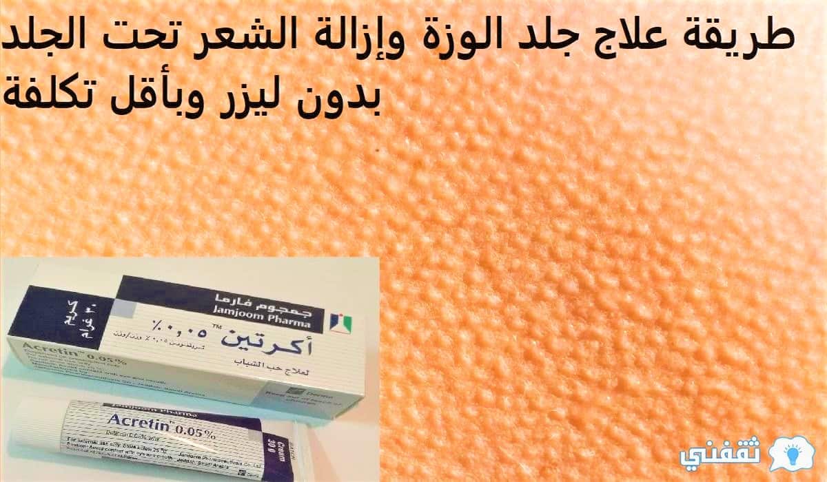 طريقة علاج جلد الوزة