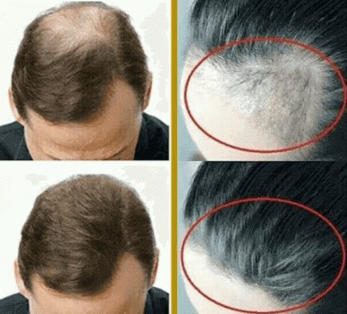 علاج تساقط الشعر والصلع أقوي علاج صرح به الخبراء والأطباء علي الإطلاق