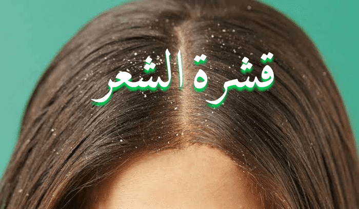 علاج قشرة الشعر