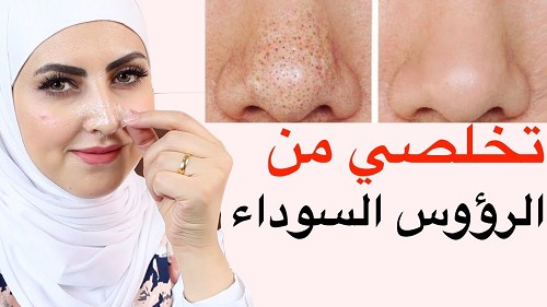 وصفة رهيبة لتنظيف الوجه والأنف من الرؤوس السوداء وعن تجربة ثقفني