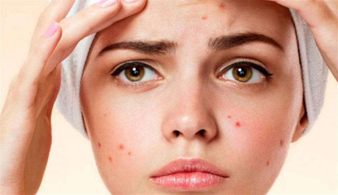 طريقه إزالة آثار الحبوب من الوجه نهائياً في 20 دقيقه بطريقه صحيه للوجه