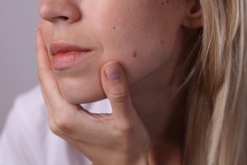 skin tags الزوائد الجلدية