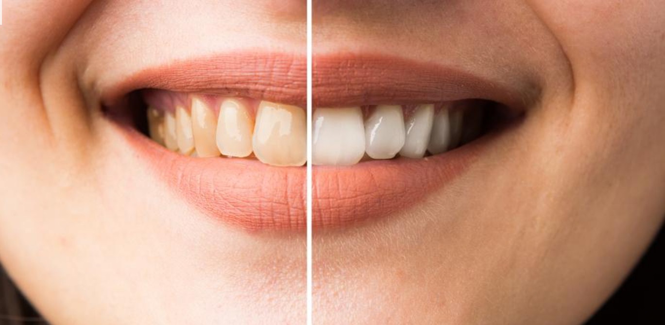 وصفة لتبيض الأسنان بمكونين فقط يمكنك الحصول على أسنان أكثر بياضًا