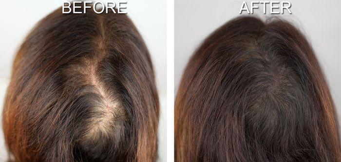 أسباب تساقط الشعر من الجذور وعلاجه نهائيا في 3 أيام باستخدام الوصفات الطبيعية