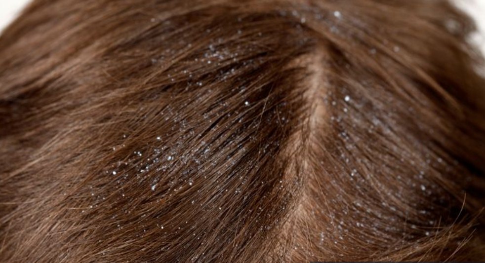 وصفات لإزالة القشرة من الشعر الدهني تخلصي من القرة نهائيا وبمكون واحد فقط