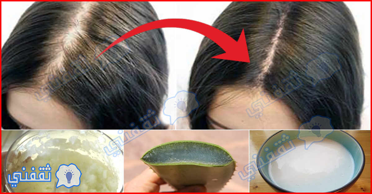 وصفة علاج تساقط الشعر والفراغات الأمامية