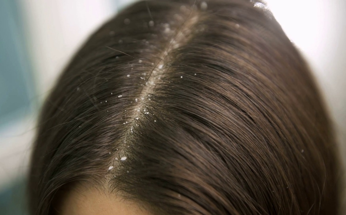 في غضون معطف بيكاديلو  علاج قشرة الشعر بأفضل الوصفات الطبيعية وطرق الوقاية منها