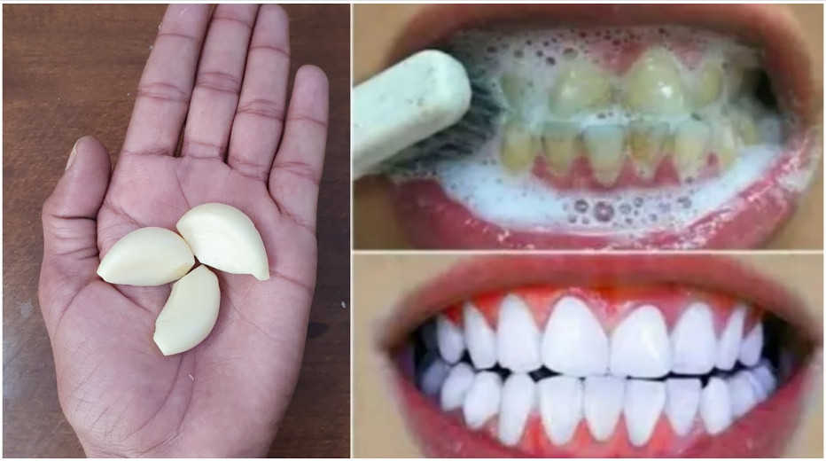 تبييض الأسنان والقضاء على الإصفرار والجير