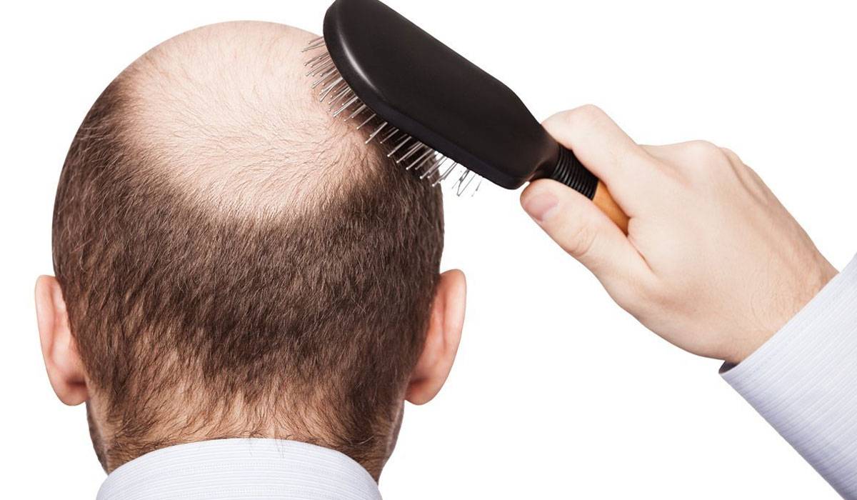 وصفات لعلاج تساقط الشعر