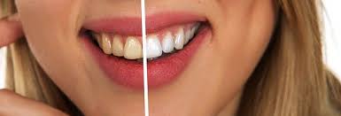طريقة العناية بالفم والاسنان وتبيض الاسنان وتوحيد لونها بوصفات طبيعية