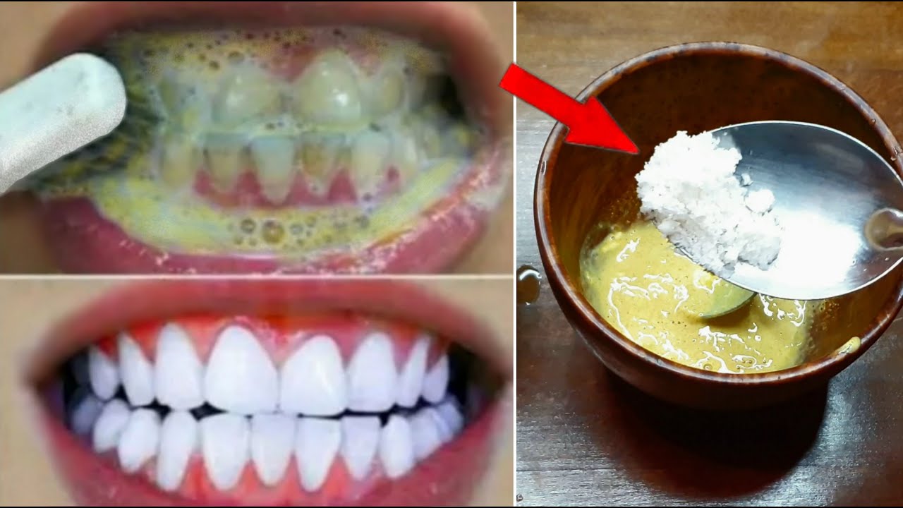 أنقذ أسنانك من الضياع.. المعجزة الربانية لتبيض الأسنان كالؤلؤ وإزالة الجير والأصفرار نهائيا في 3 دقائق