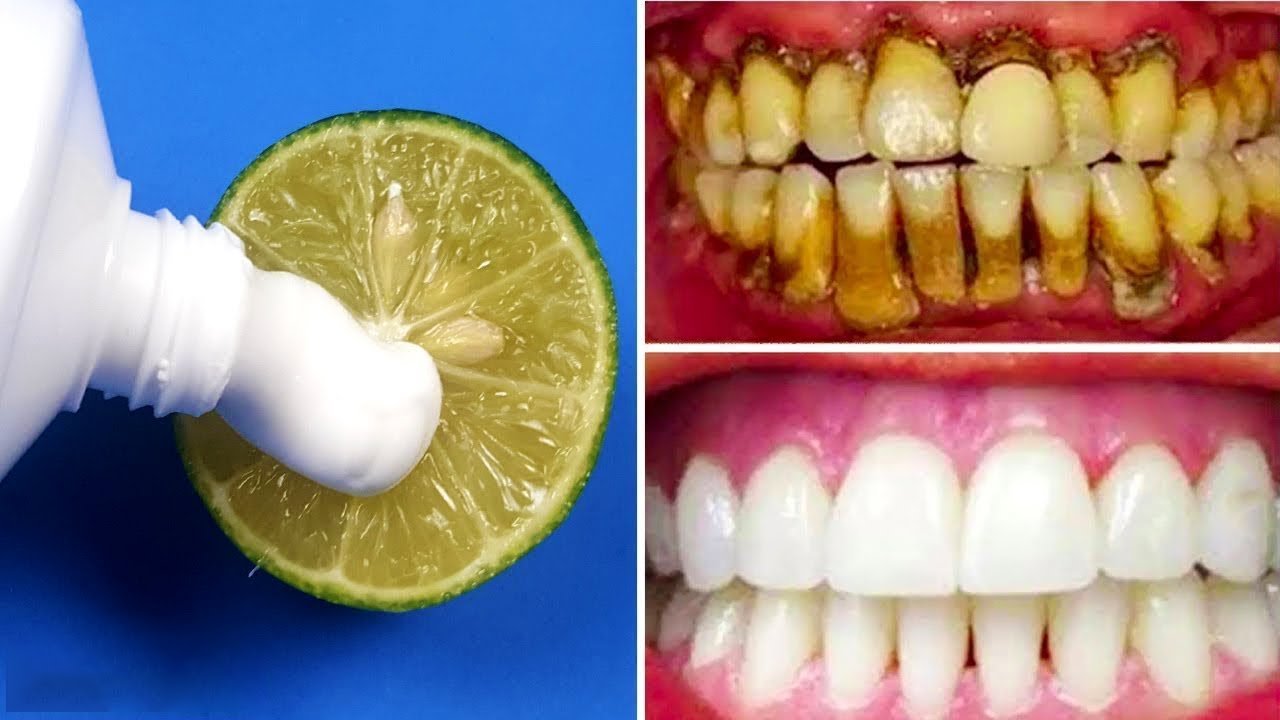 الحل النهائي لانقاذ اسنانك.. تبييض الأسنان وإزالة الجير في 3 دقائق فقط بمكون سحري في مطبخك
