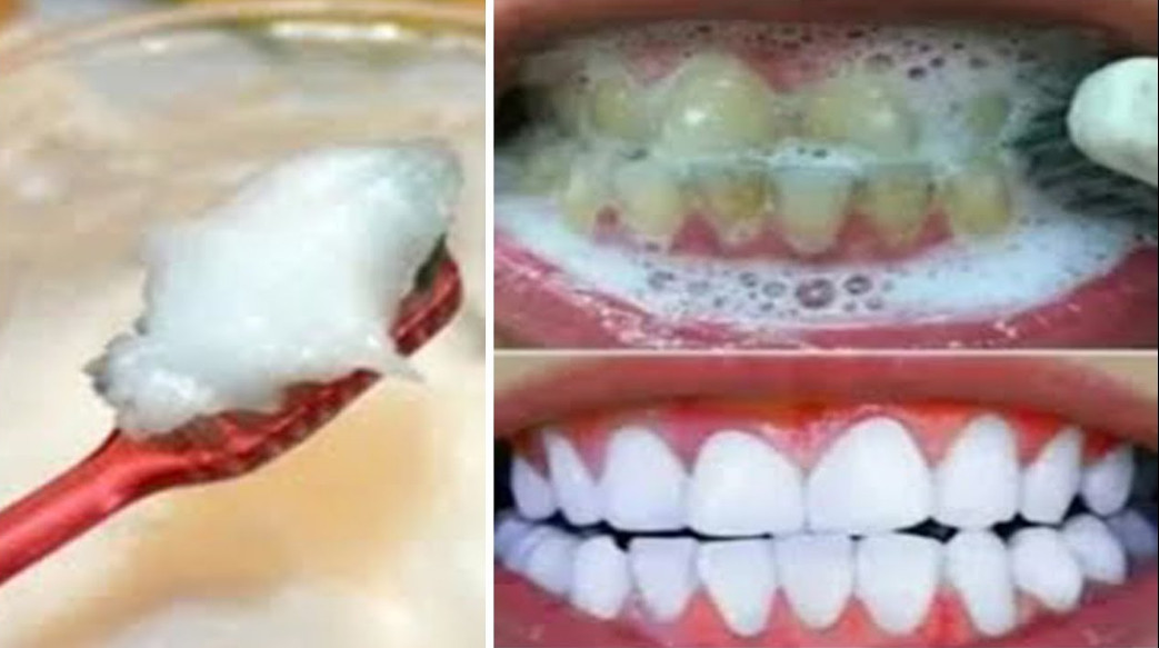 تبييض الأسنان وإزالة الجير والاصفرار