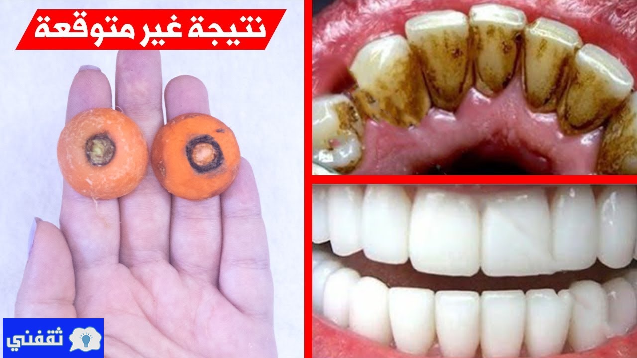 أنقذ أسنانك من الضياع.. تبيض الأسنان كالؤلؤ وازالة الجير بمكون سحري موجود في كل منزل