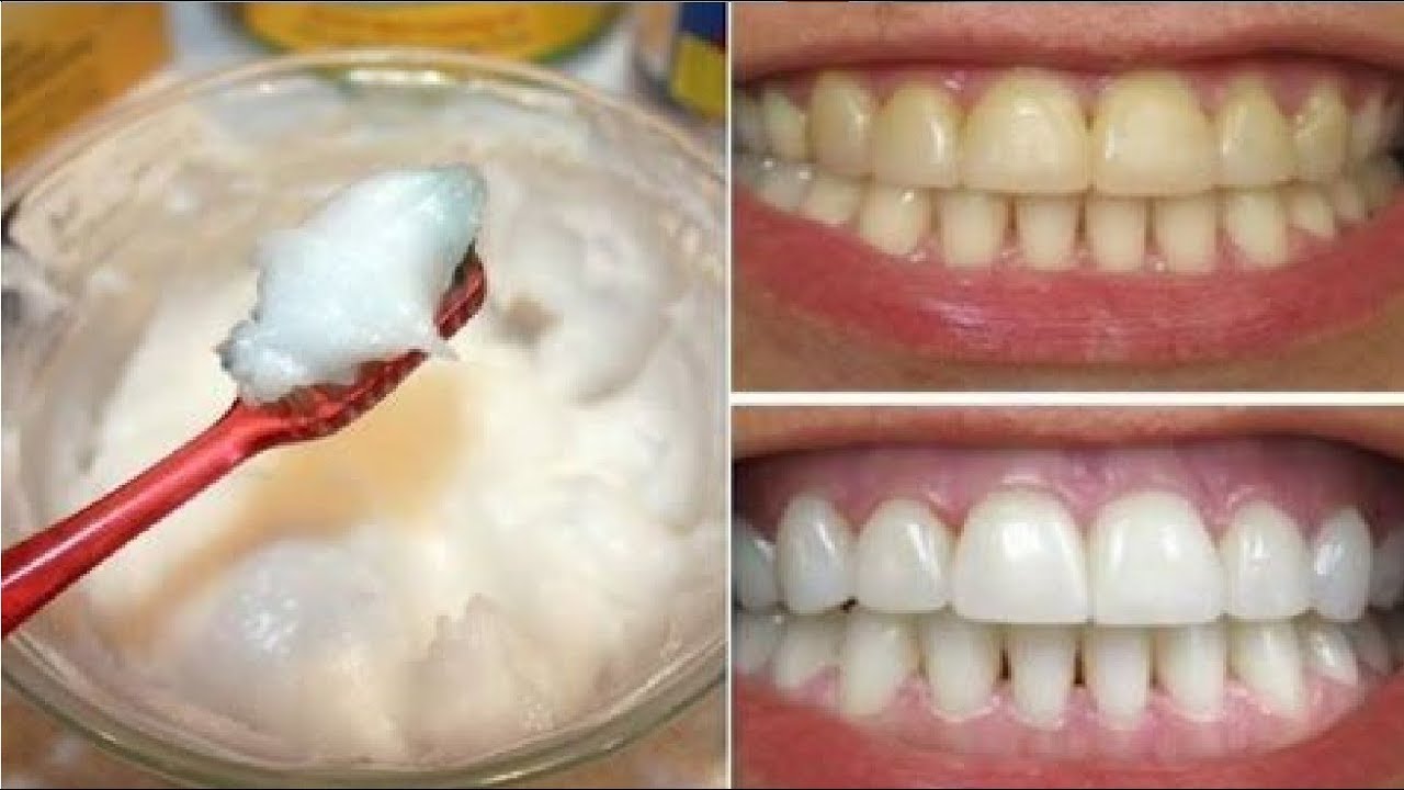 سر مفعول الملح في تبييض الأسنان وإزالة الجير والاصفرار هتكون أسنانك زى الولوء من أول مرة