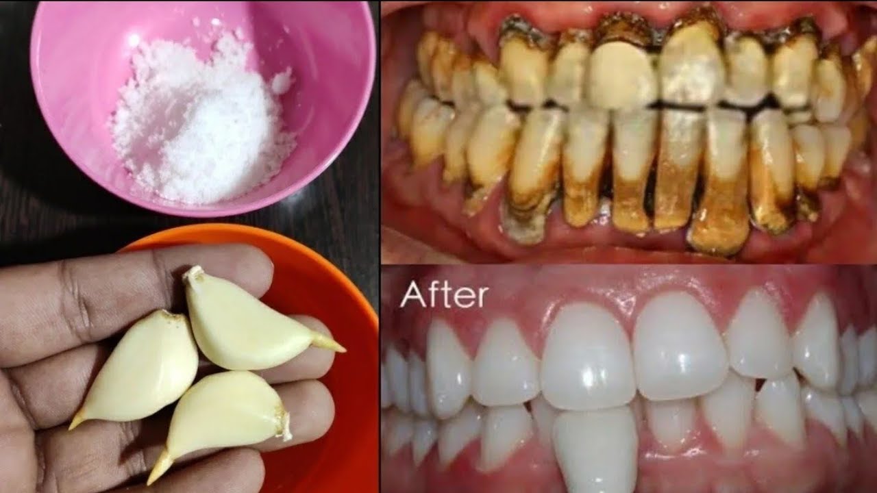 طريقة عمل وصفة تبييض الأسنان