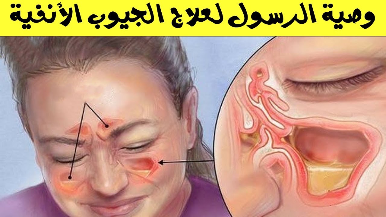 علاج انسداد الأنف بدون زكام