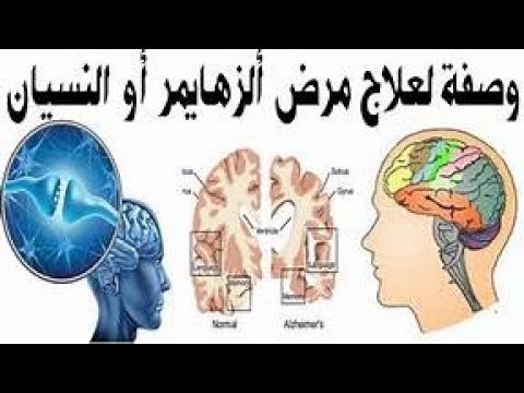 علاج الزهايمر و النسيان