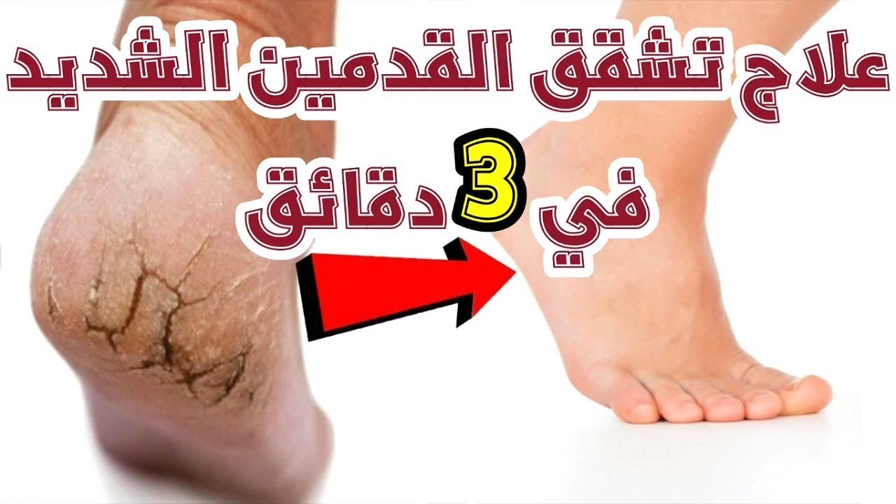 بملعقة خل واحدة تخلصي من اسمرار القدمين والتشققات من أول استعمال وللابد