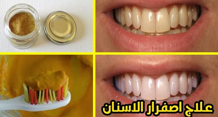  أسنانك صفراء وفيها جير... تعالى أقولك على طرق طبيعية لإزالة الأصفر وتسقط الجير وتبيض الأسنان مثل اللؤلؤ