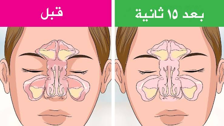 علاج الجيوب الأنفية