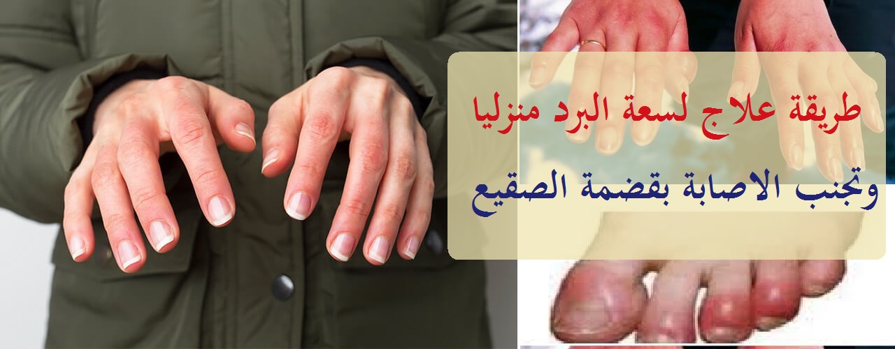 كيفية علاج لسعة البرد أو قضمة الصقيع في اليدين والقدمين و الأطراف
