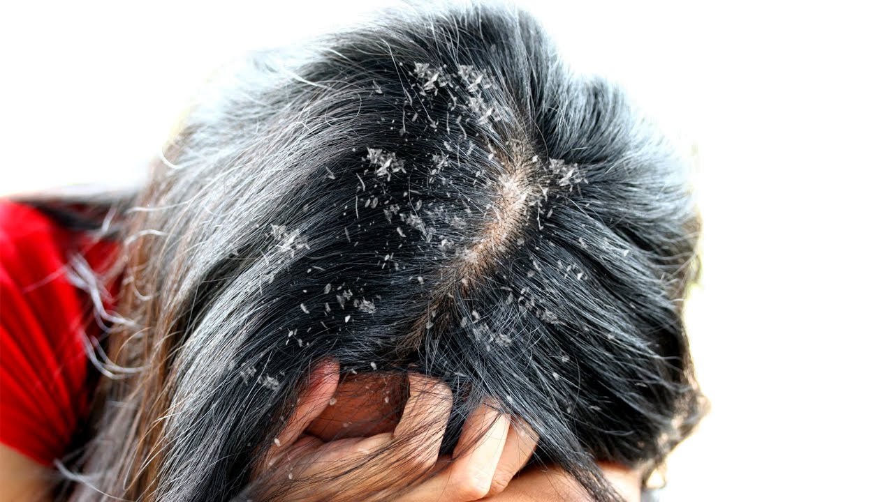 وصفات علاج قشره الشعر