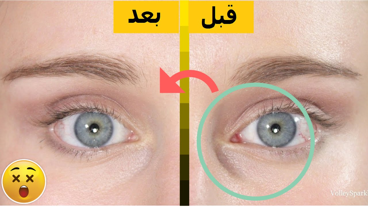 علاج تجاعيد العين طبيعيا