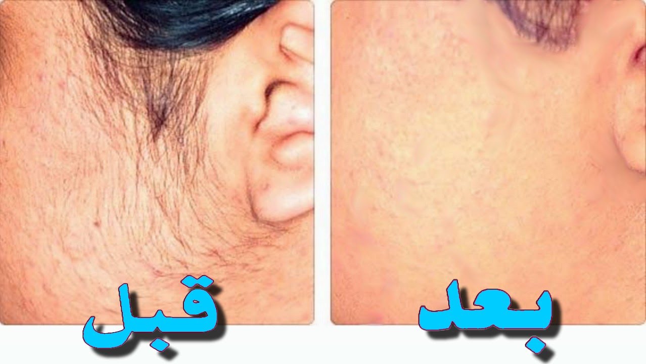 طريقة إزالة الشعر نهائيا بالملح والفازلين