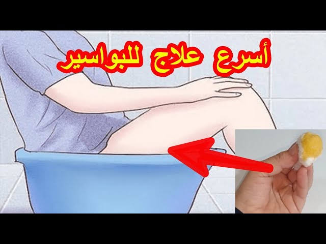 علاج البواسير