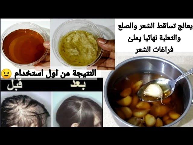 علاج تساقط الشعر