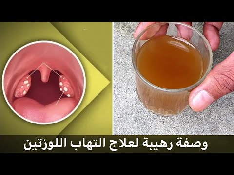 علاج التهاب الحلق