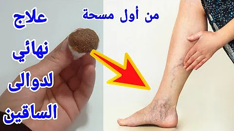 علاج الدوالي بورق الغار