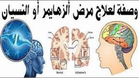 علاج الزهايمر و النسيان