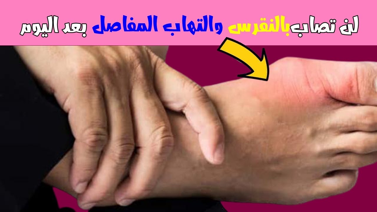 علاج النقرس بالأعشاب