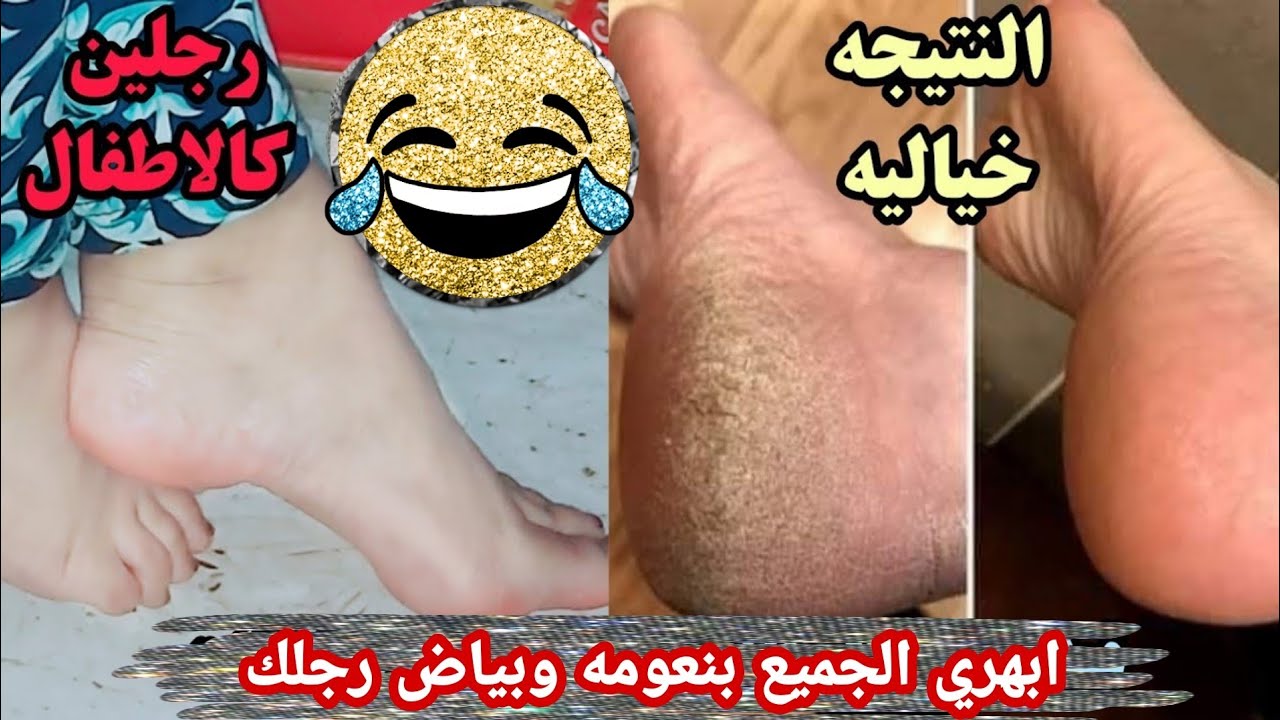 التخلص من تشققات القدمين