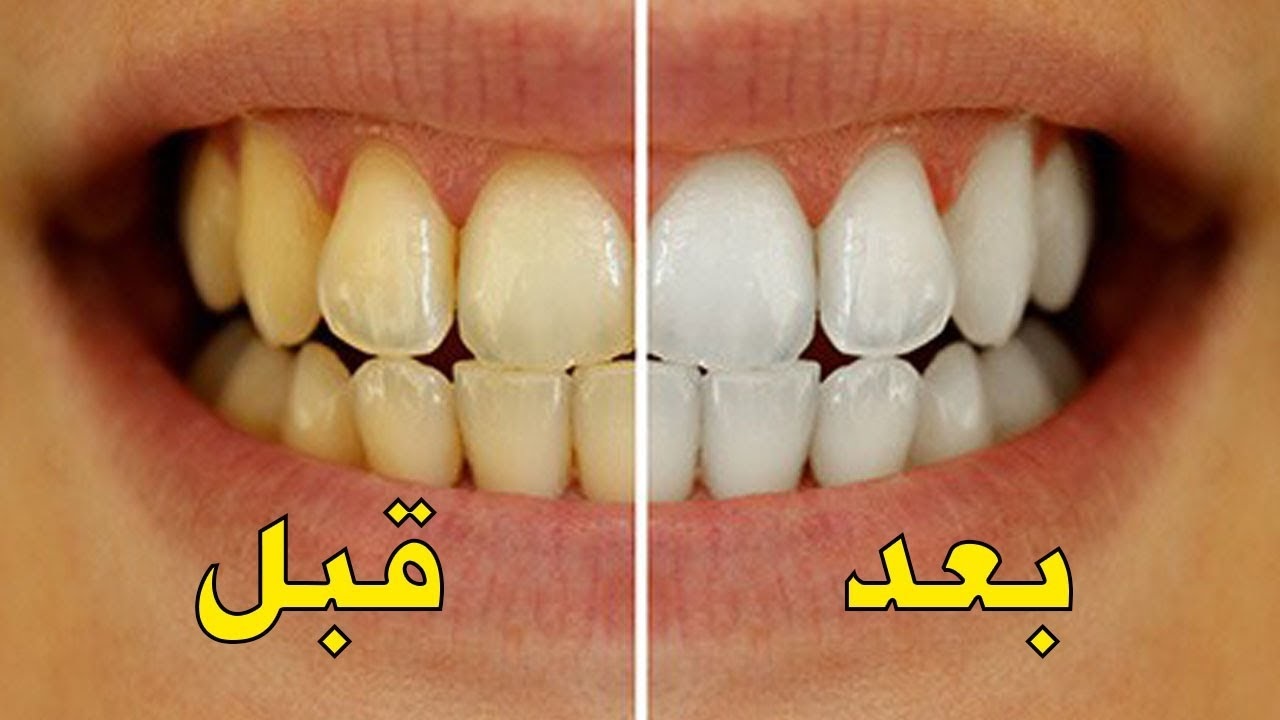 الحل النهائي.. لتبييض الأسنان وإزالة الجير والاصفرار والتكلس في ثواني بطريقة طبيعية منزلية