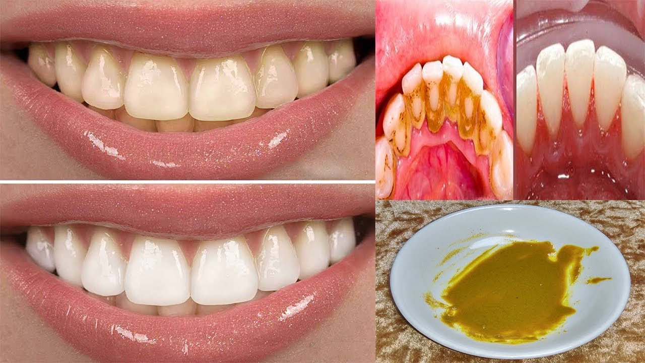 وصفة لتبييض الأسنان من الصفار