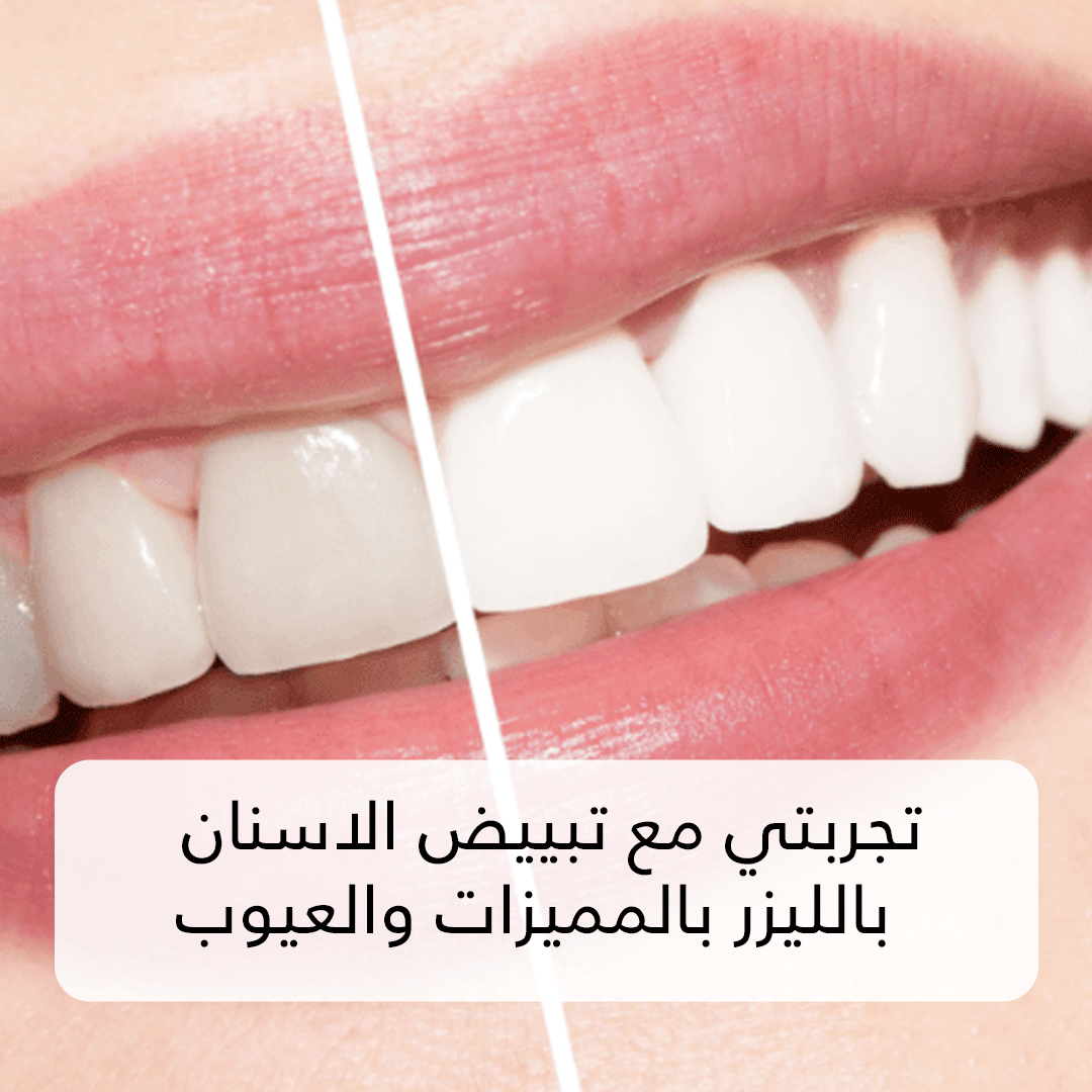 تجربتي مع تبييض الاسنان بالليزر