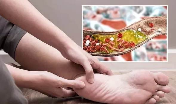 احذر وبشدة.. علامات خطيرة إذا ظهرت على أصابع قدميك تشير إلى إرتفاع نسبة الكوليسترول في الدم أذهب إلى الطبيب فوراً