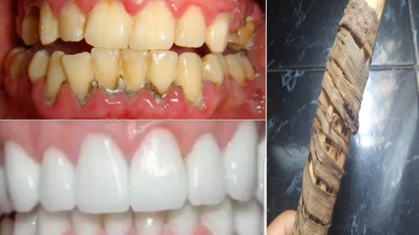 الخلطة الجبارة لتبيض الاسنان والتخلص من الجير والتكلسات في منزلك بدون الذهاب الى الطبيب