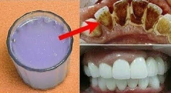 تبييض الأسنان بالبيكنج بودر خلال دقيقتين فقط وصفة سحرية منزلية صحية تجعل الأسنان أكثر بياضا
