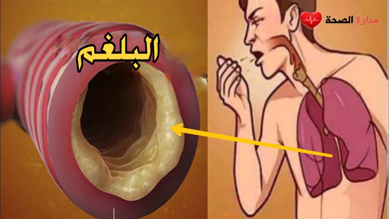 عندما تمتلئ رئتيك بالبلغم هذا أفضل مشروب لطرد البلغم وعلاج نزلات البرد خلال ساعتين